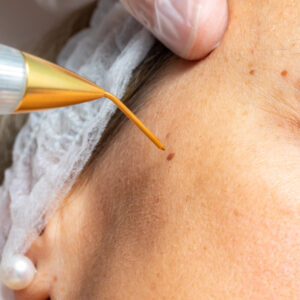 Plasma Pen removal of lesions CPD course -  Call 01908 310372 for availability